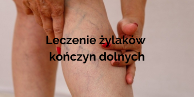leczenie żylaków kończyn dolnych